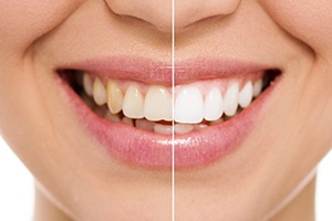 Closeup of teeth half before and half after whitening