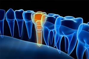 Animation of implant supported dental crown