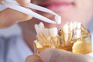 Model of implant supported dental crown